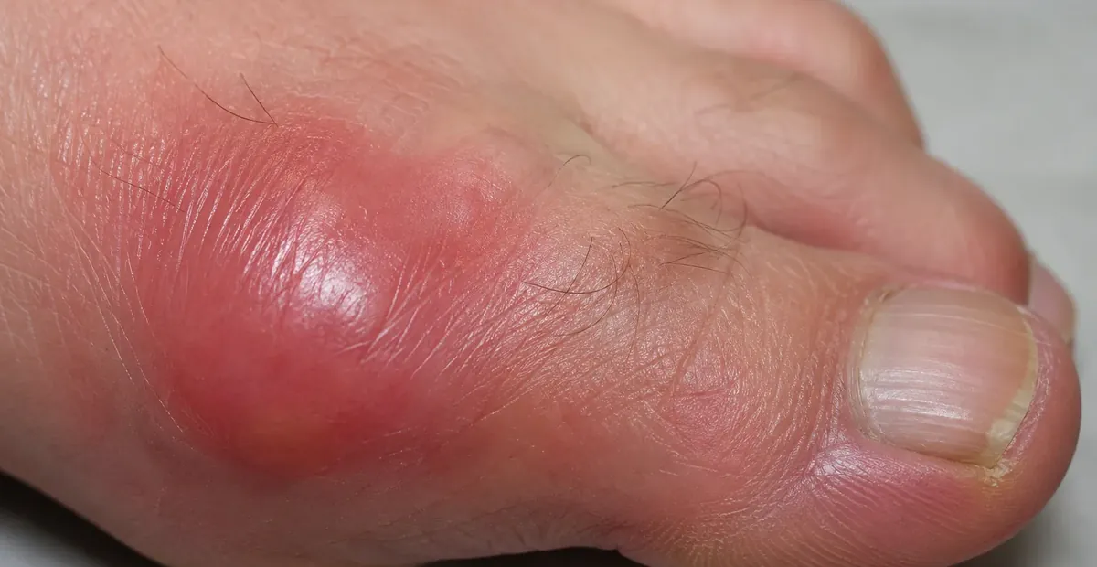 Gout