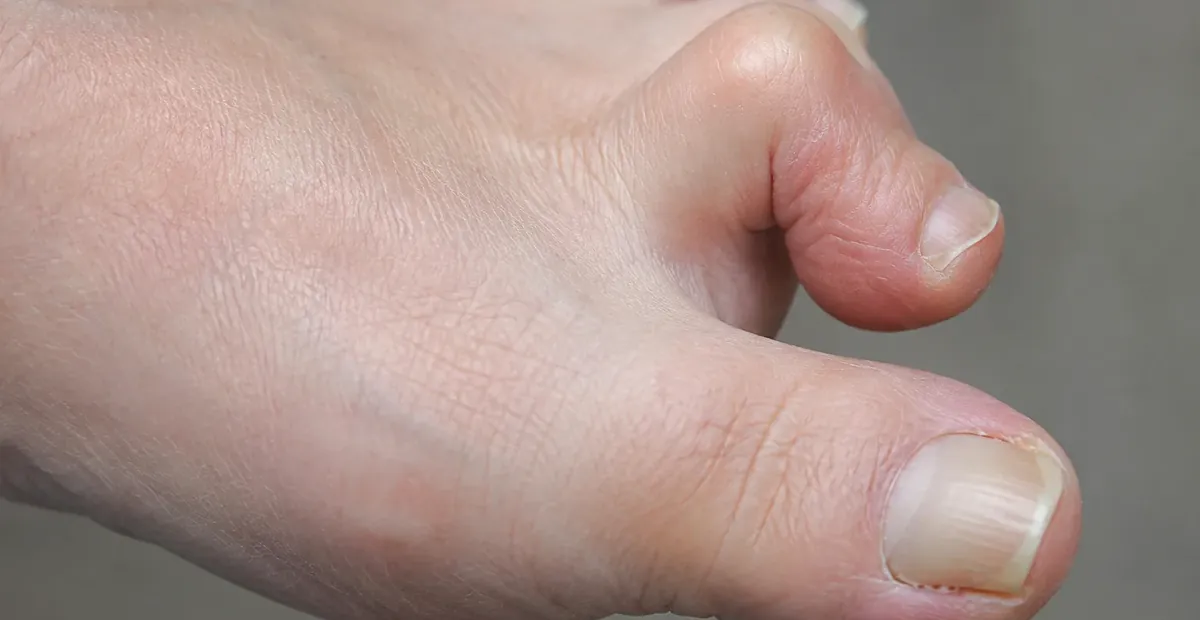 Hammertoes