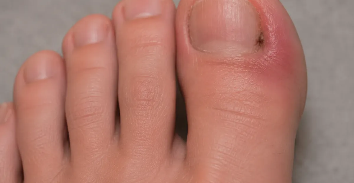 Ingrown Toenails