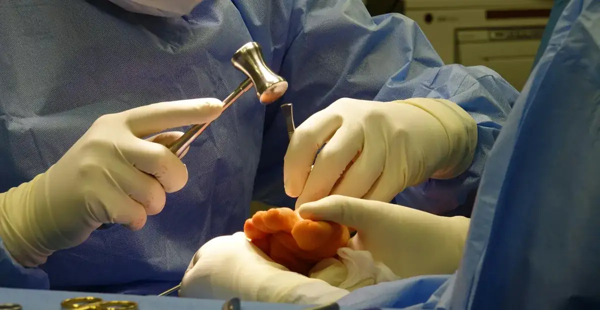 Lapiplasty Bunion Correction