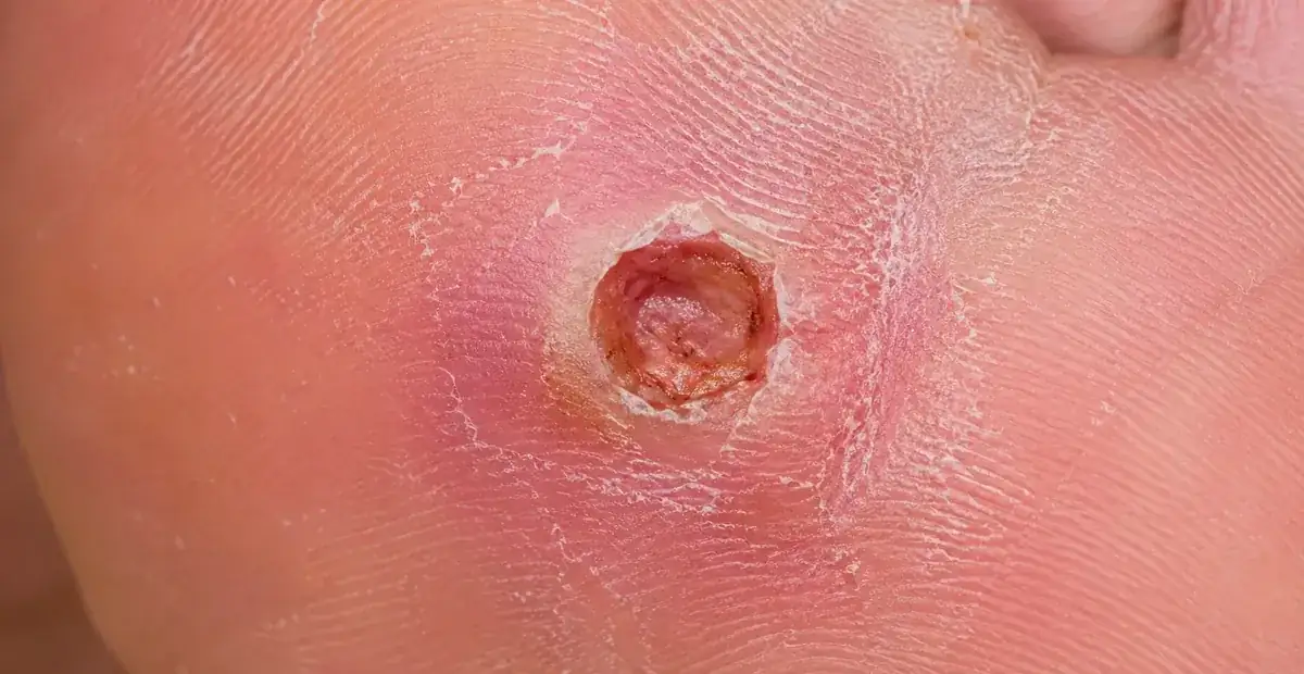 Limb Salvage / Amputation Prevention